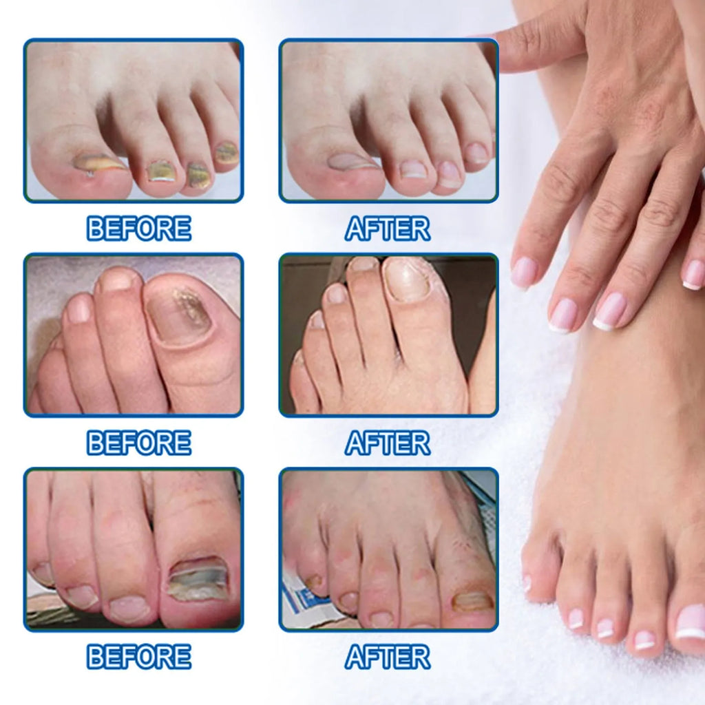 Box of nail repair adhesive bandage patches with ingredients glycerin, allantoin, vitamin E, tea tree oil.