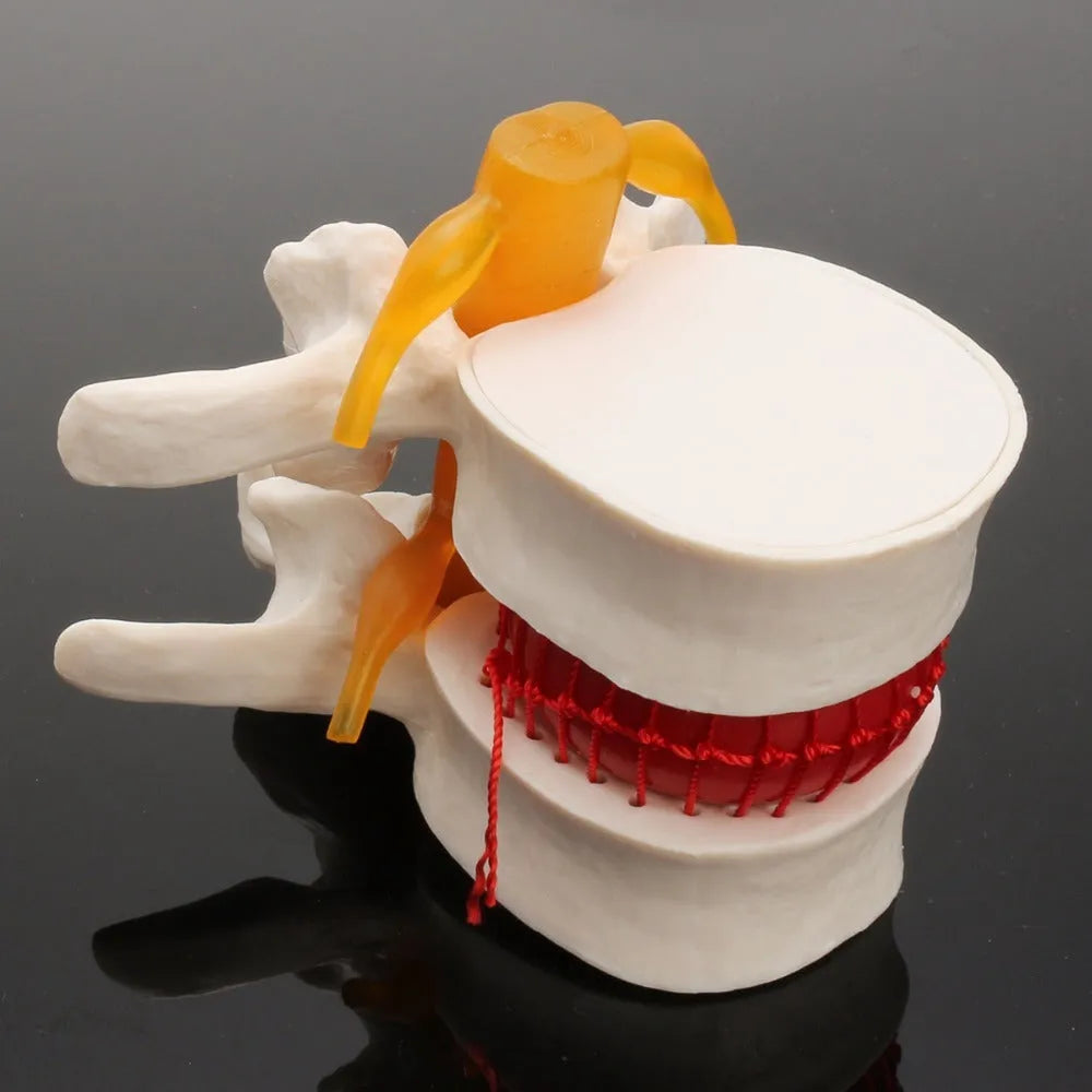 White PVC anatomical model of lumbar spine showing herniated intervertebral disc condition