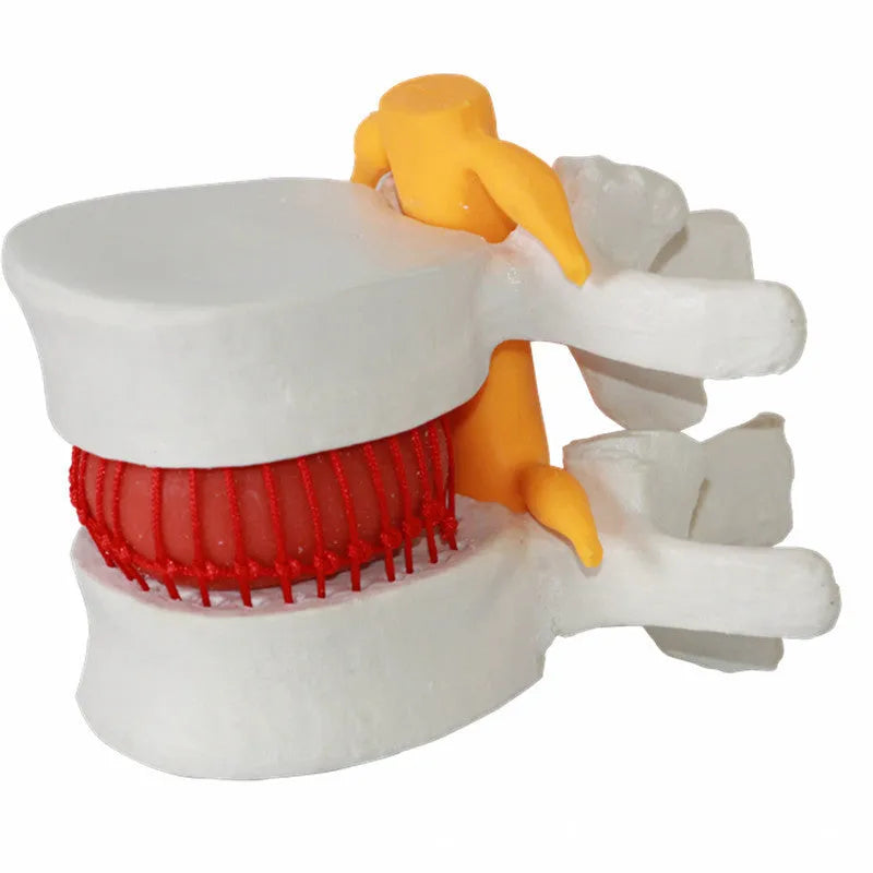 White PVC anatomical model of lumbar spine showing herniated intervertebral disc condition