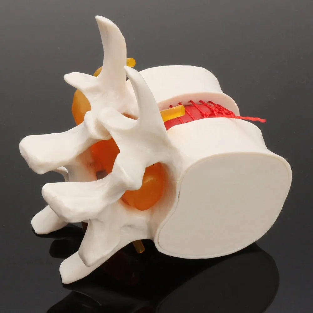 White PVC anatomical model of lumbar spine showing herniated intervertebral disc condition
