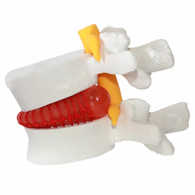 White PVC anatomical model of lumbar spine showing herniated intervertebral disc condition
