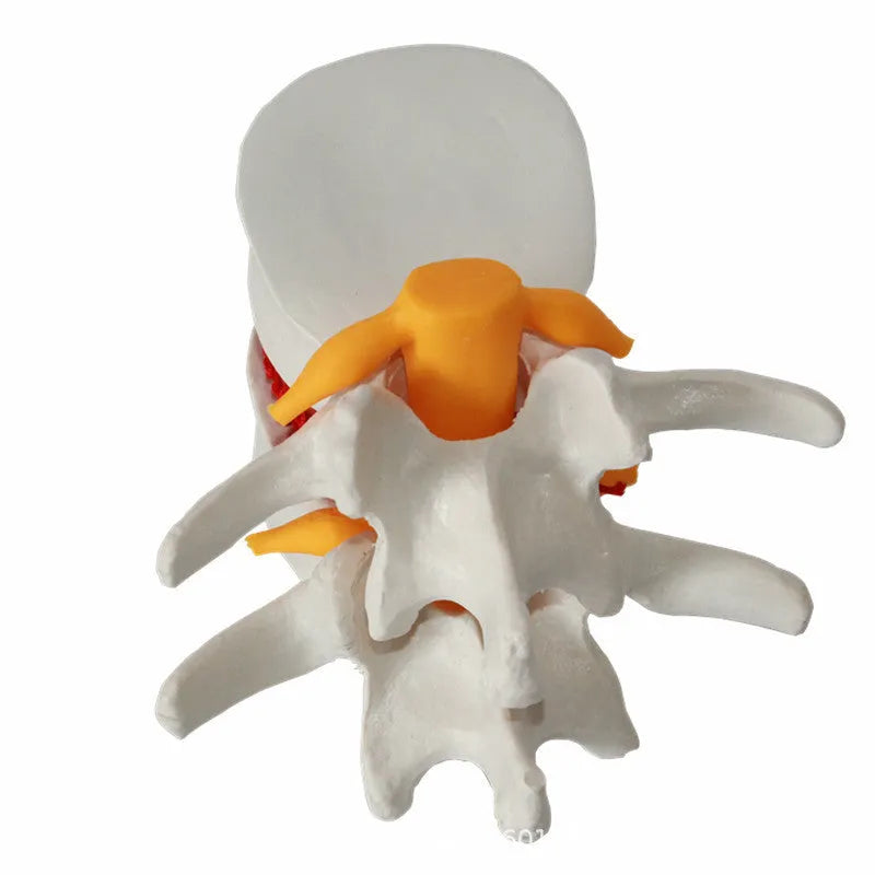 White PVC anatomical model of lumbar spine showing herniated intervertebral disc condition