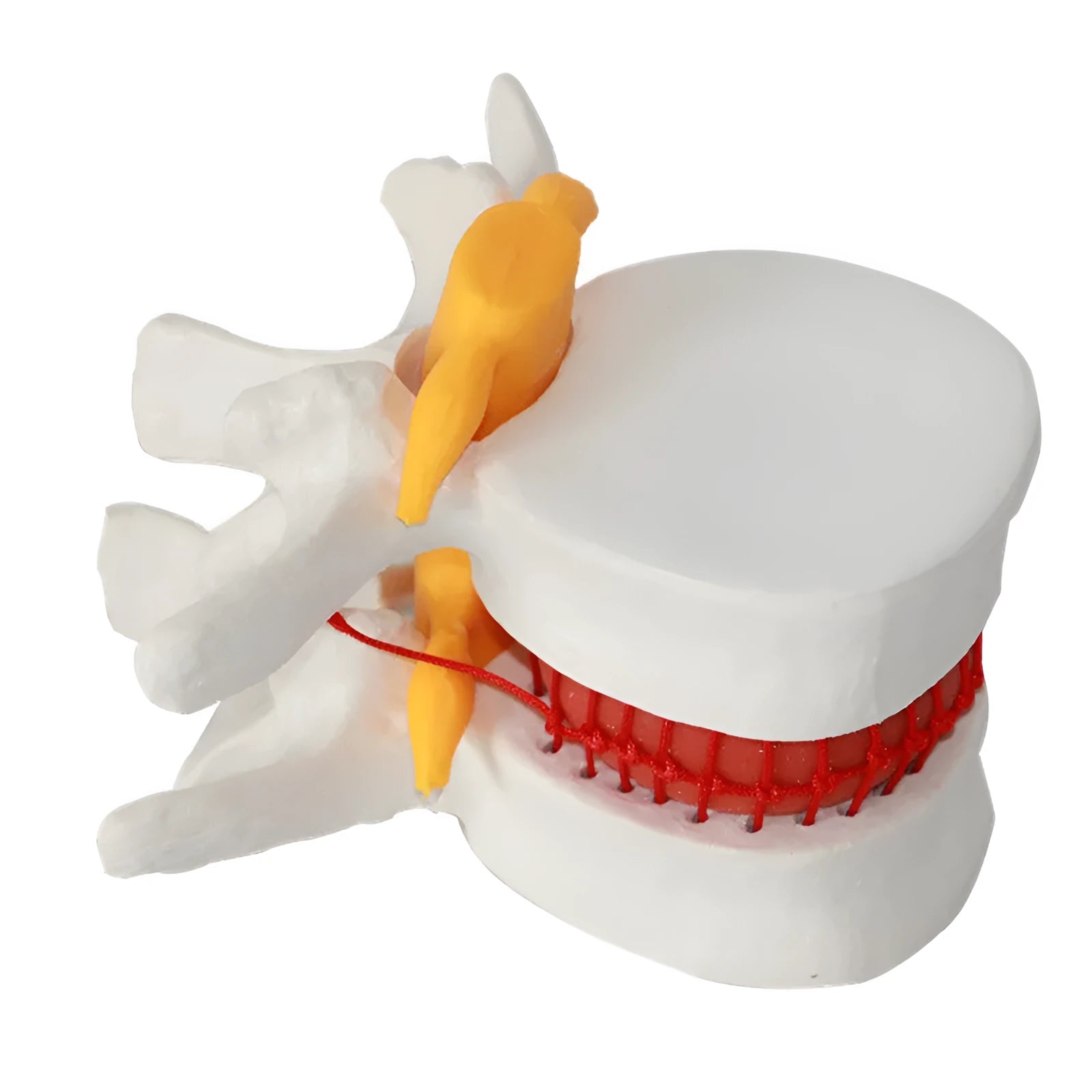 White PVC anatomical model of lumbar spine showing herniated intervertebral disc condition