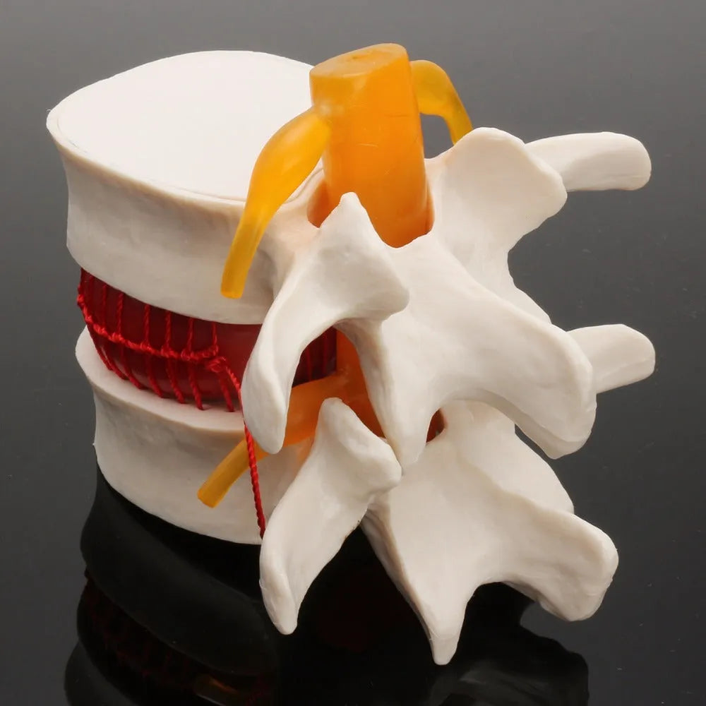White PVC anatomical model of lumbar spine showing herniated intervertebral disc condition