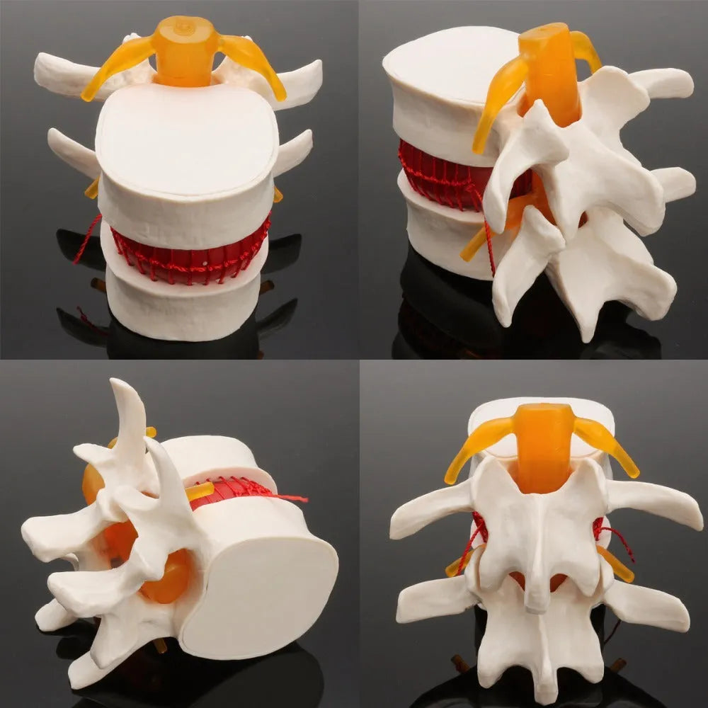 White PVC anatomical model of lumbar spine showing herniated intervertebral disc condition