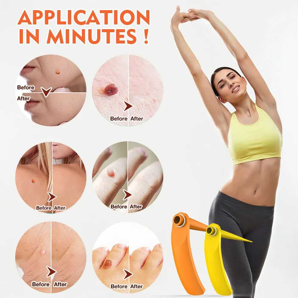 Orange-yellow mole remover tool kit with two devices, rubber rings, alcohol swabs, and accessories